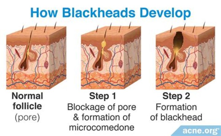 Are blackheads caused by poor hygiene?