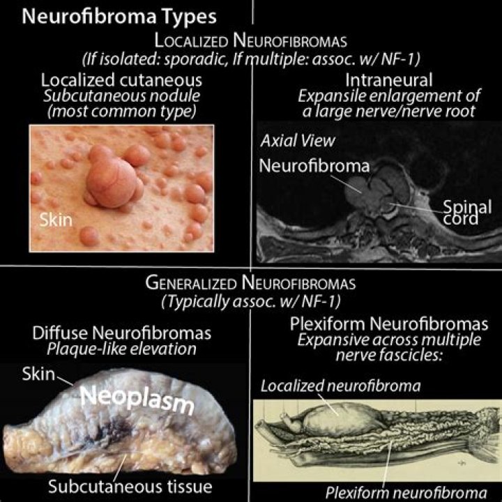 Are neurofibromas firm?
