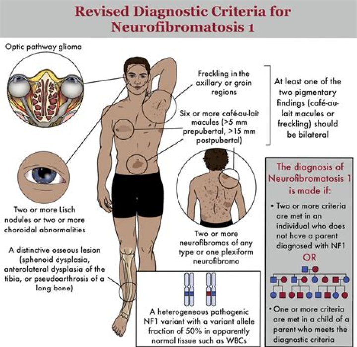 At what age is neurofibromatosis usually diagnosed?
