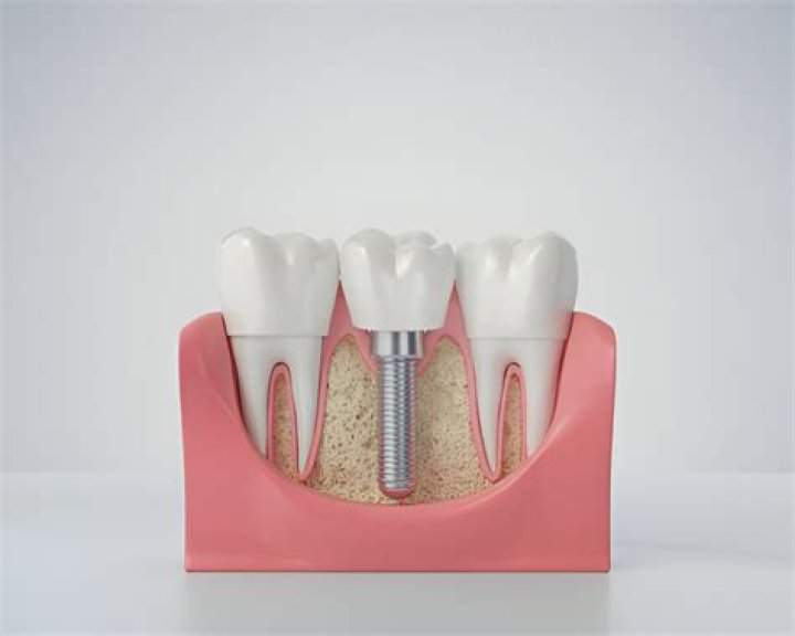 Can 1 implant replace 2 teeth?