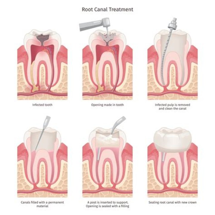 Can a root canal tooth last a lifetime?