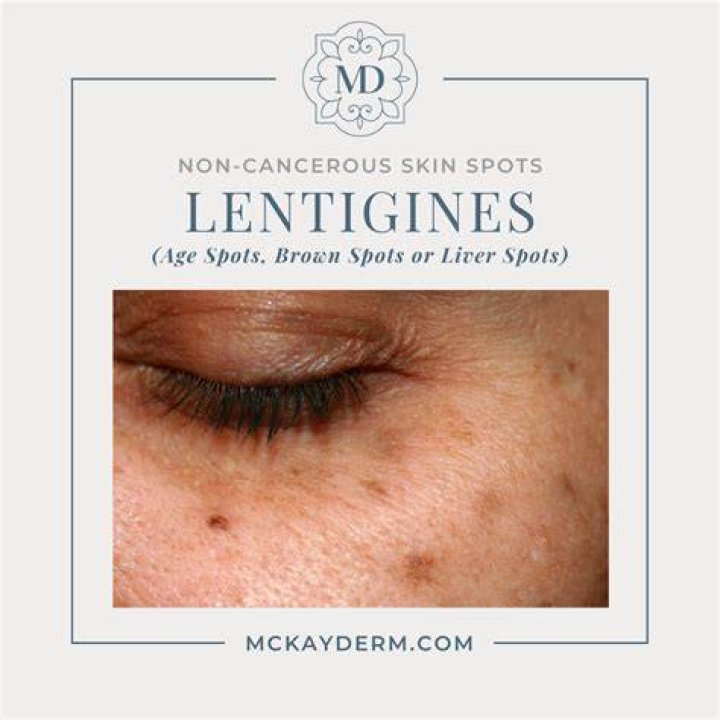Can age spots be flaky?