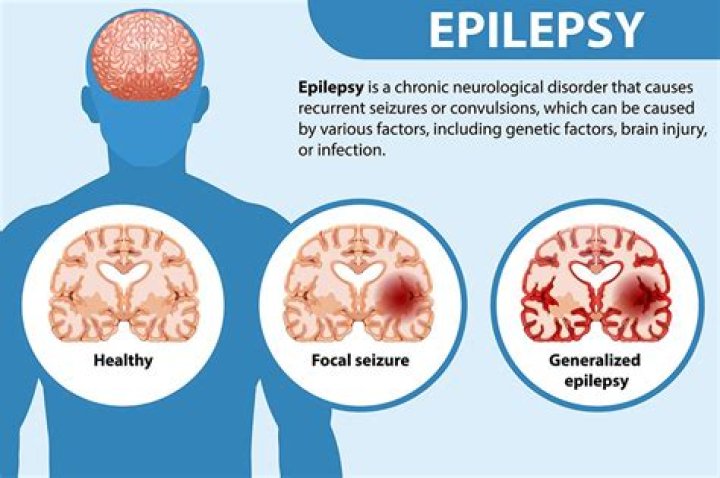 Can an epilepsy diagnosis be wrong?