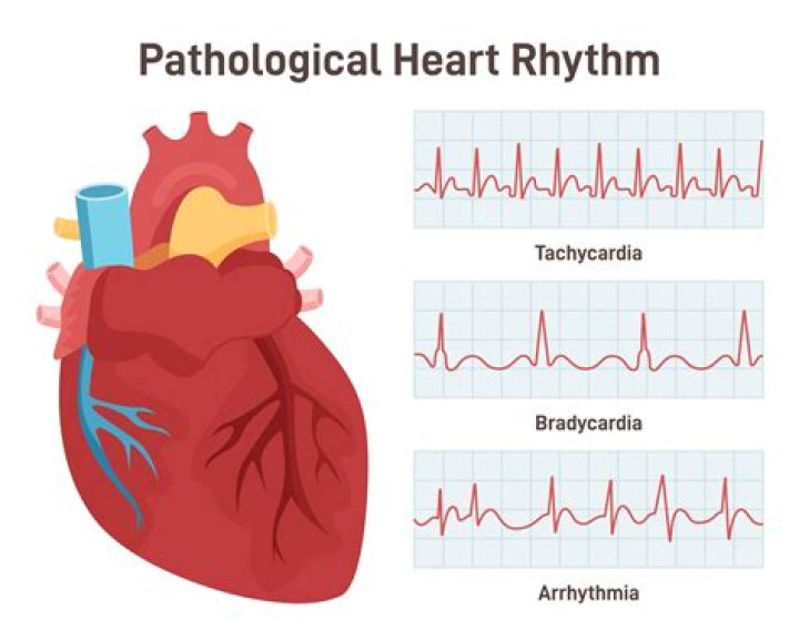 Can Benadryl cause arrhythmia?
