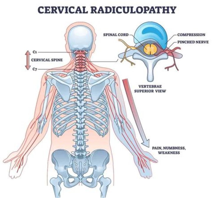Can cervical dysplasia come back?