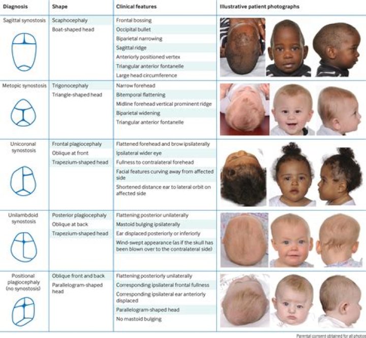 Can craniosynostosis cause mental illness?