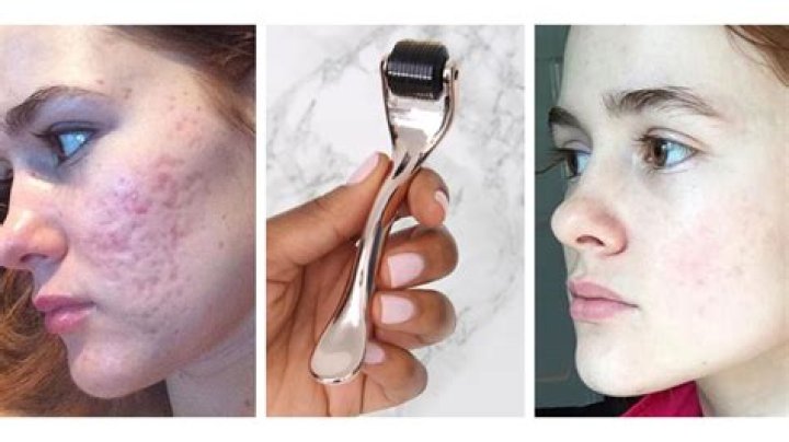 Can derma rolling damage skin?