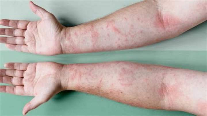 Can eczema lead to other diseases?