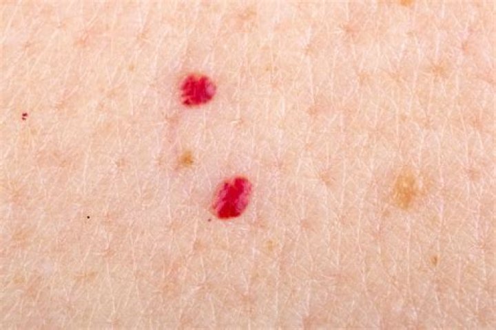 Can freckles be red?
