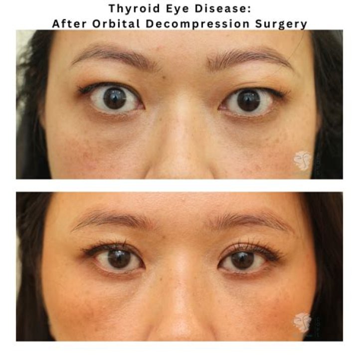 Can hypothyroidism cause under eye bags?
