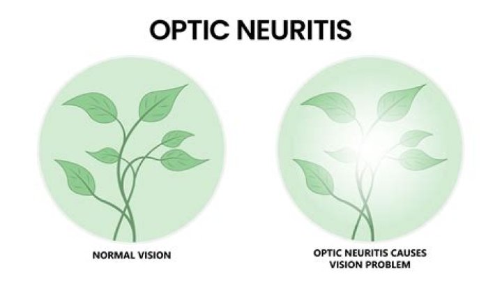 Can I drive with optic neuritis?
