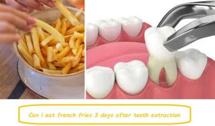 Can I eat fries after tooth extraction?