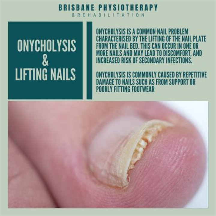 Can I still get a fill if my nails are lifting?