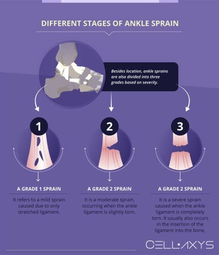 Can I walk on my sprained ankle after 3 days?