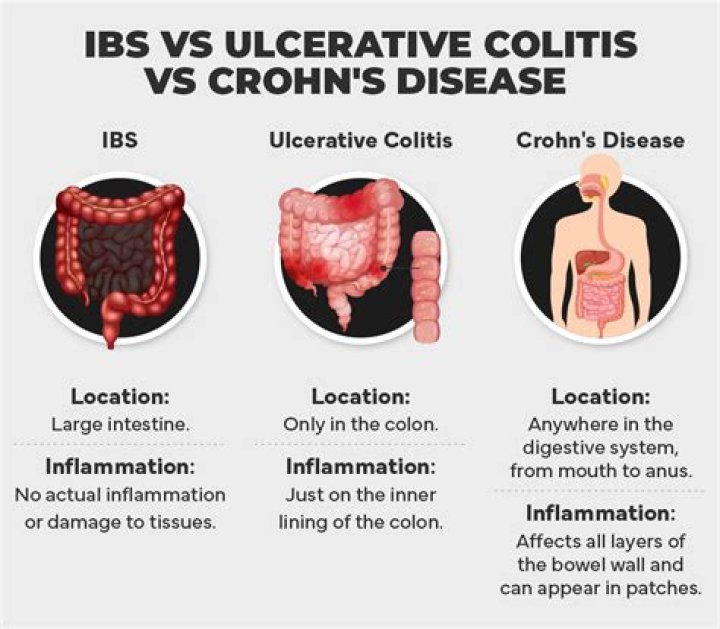 Can IBS turn into Crohn disease?