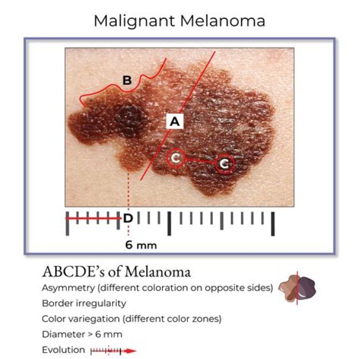 Can melanoma be 1mm wide?