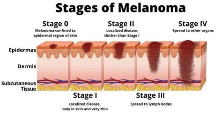 Can melanoma go away on its own?