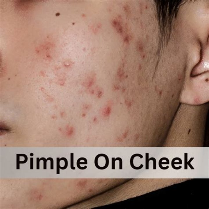 Can oil massage cause pimples?