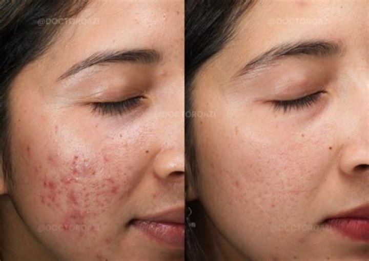 Can petrolatum cause acne?