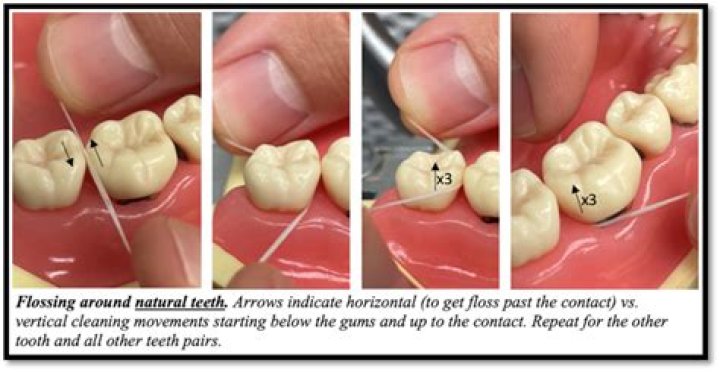 Can plaque come off while flossing?