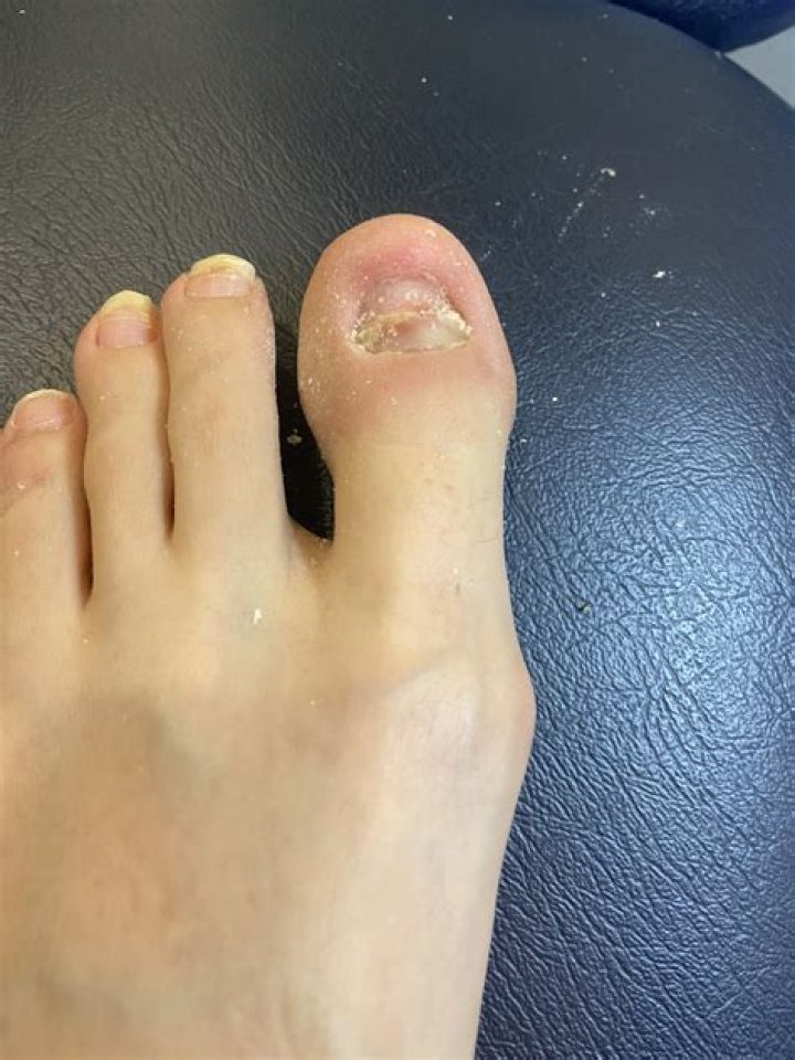 Can specs be removed permanently?