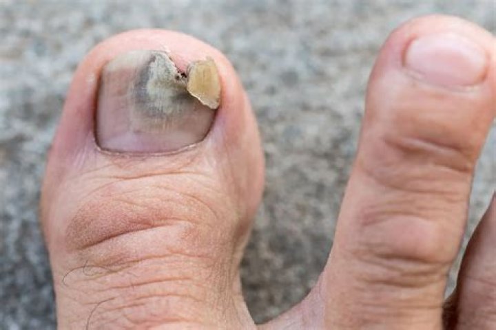 Can toenail fungus spread to skin?
