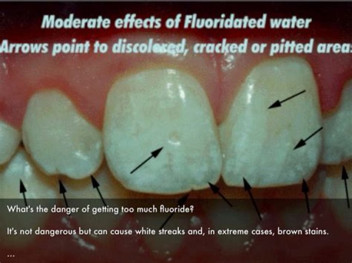 Can too much fluoride cause white spots on teeth?