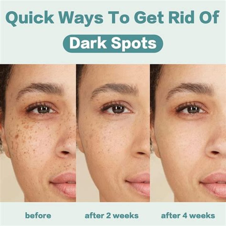 Can toothpaste lighten dark spots?