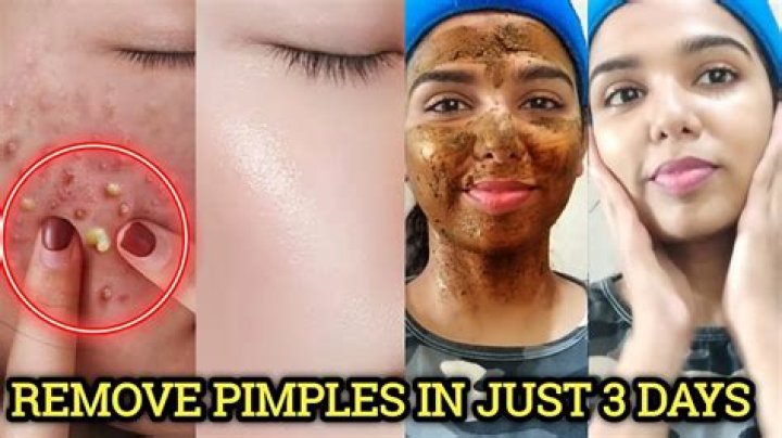 Can we apply turmeric on pimples everyday?