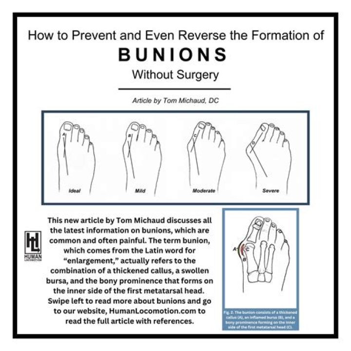 Can you dissolve a bunion?