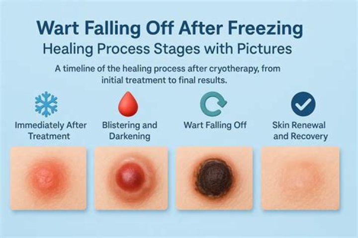 Can you freeze off dermatofibroma?