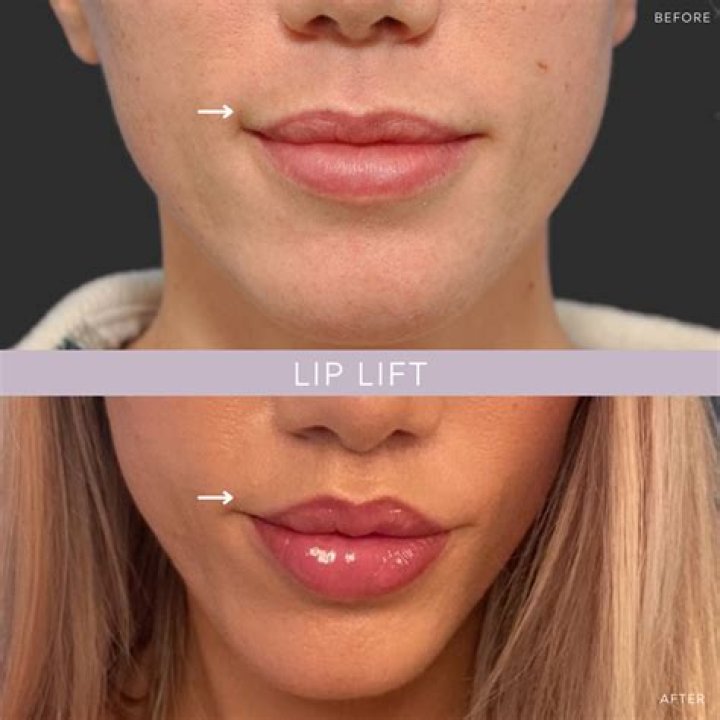 Can you get a lip lift with a nose job?
