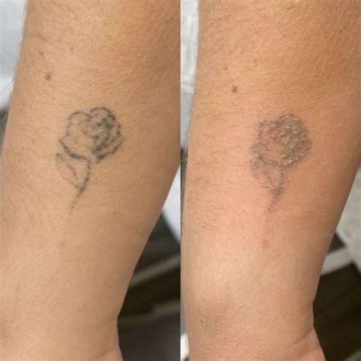 Can you get a tattoo on wrinkled skin?