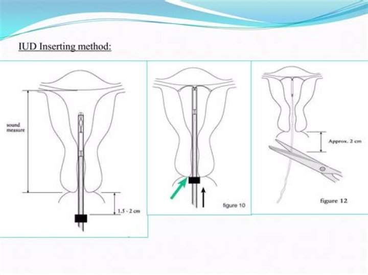 Can you get local anesthesia for IUD?