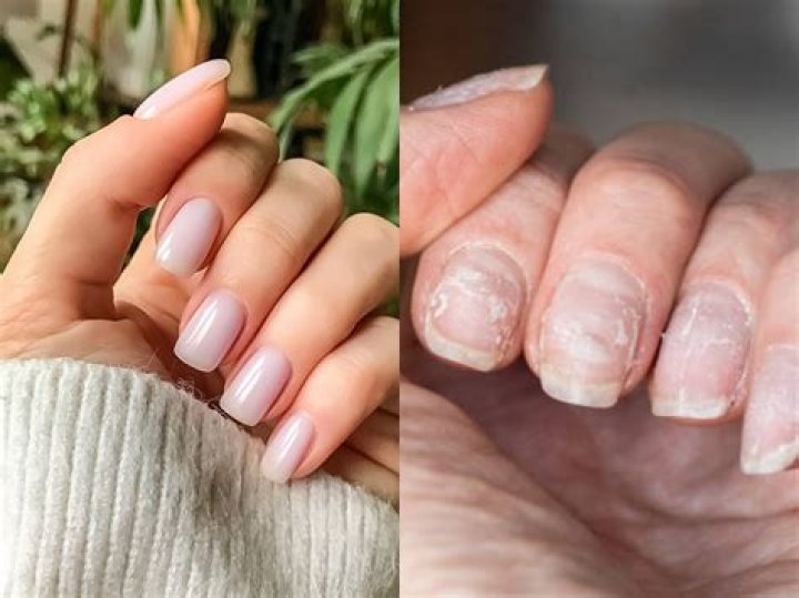 Can you have acrylics during surgery?