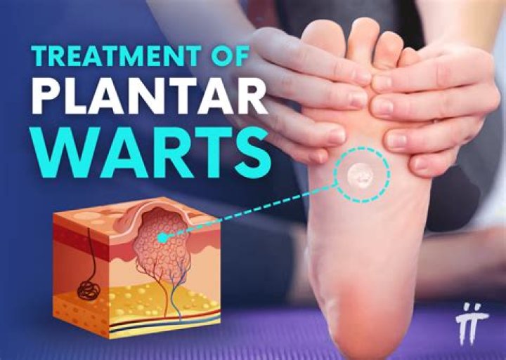 Can you pull a plantar wart out with tweezers?