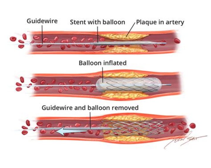 Can you undo an S election?