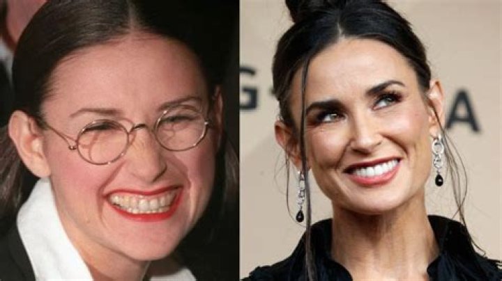 Did Julia Roberts have veneers?
