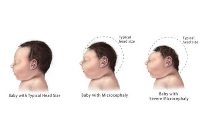 Do autistic babies have small heads?