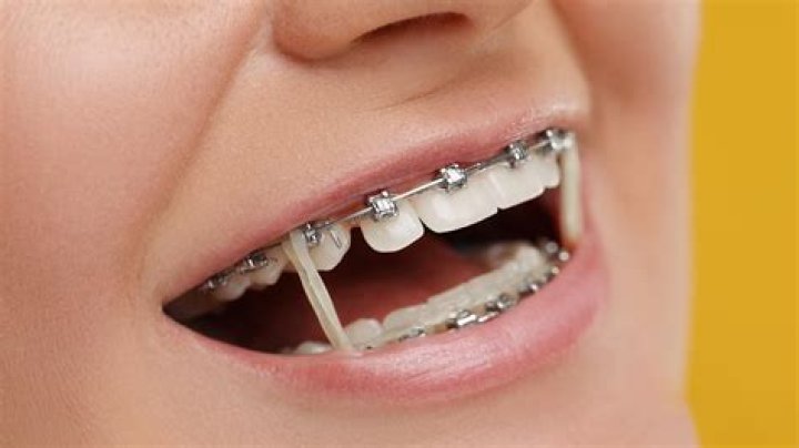 Do braces feel tight?