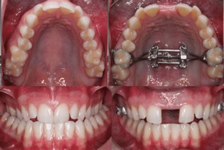 Do expanders hurt?