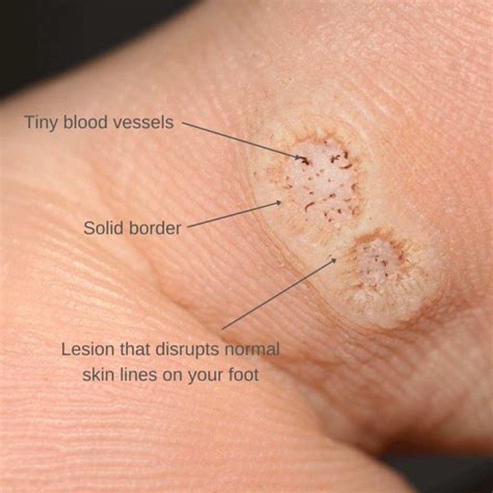 Do HPV warts disappear?