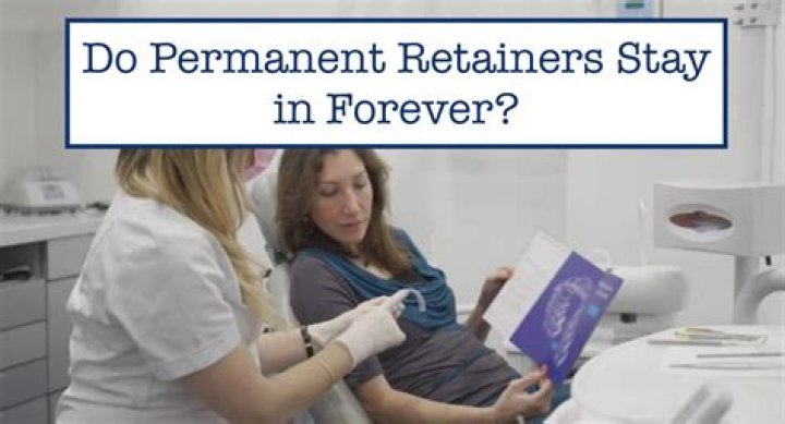 Do permanent retainers stay in forever?