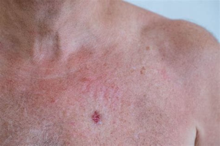 Do skin cancers sting?