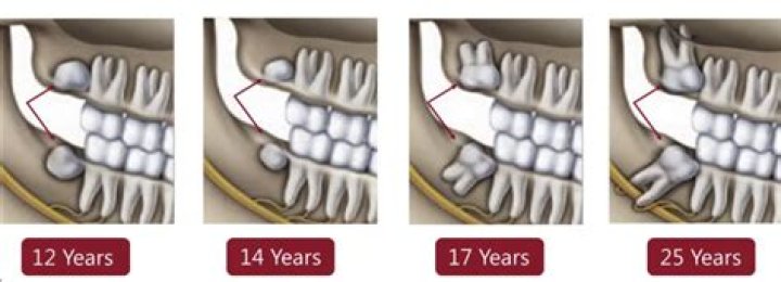 Do wisdom teeth grow back?
