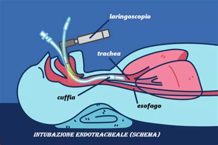 Do you get intubated for a colonoscopy?