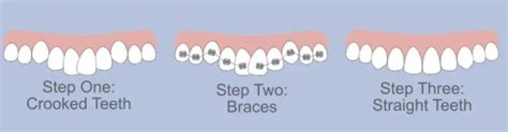 Do you get top and bottom braces on the same day?