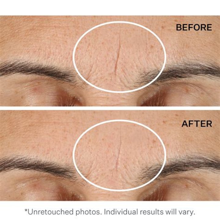 Does a potato get rid of wrinkles?