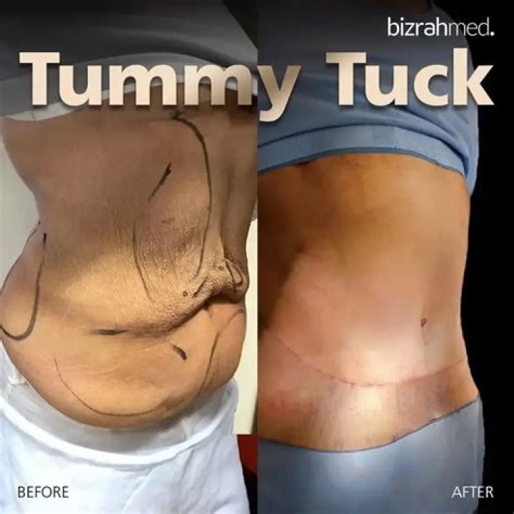 Does a tummy tuck remove back fat?