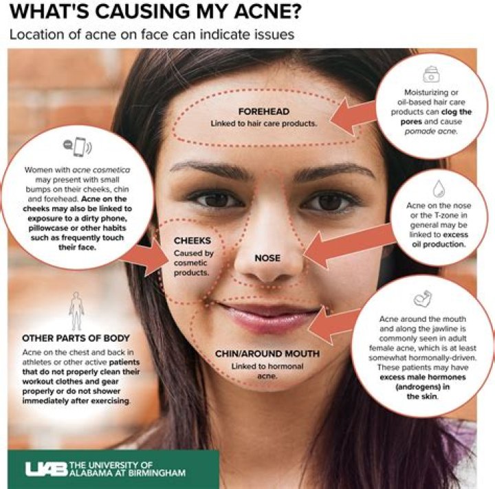 Does acne come from Mom or Dad?